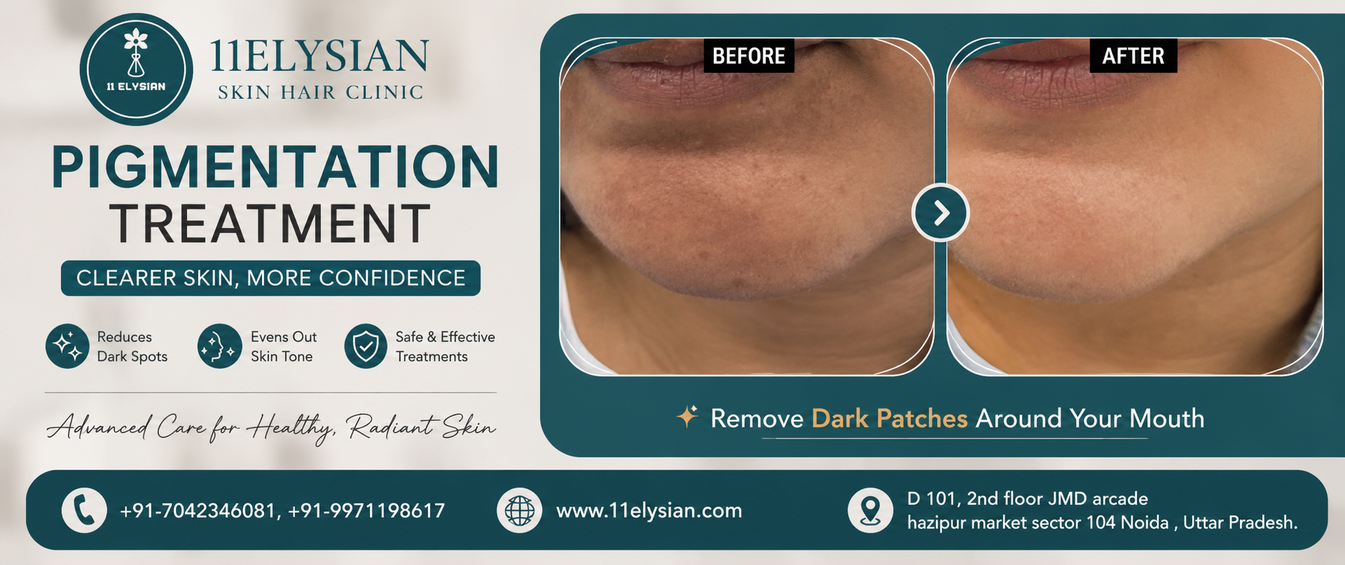 Pigmentation Treatment Near Sector 50, Noida